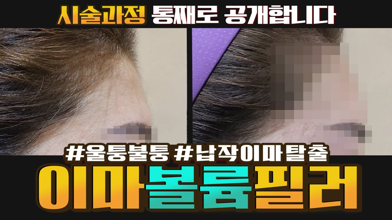 아무도 뭐르게 이뻐진 이마모양 좀 볼래? 썸네일