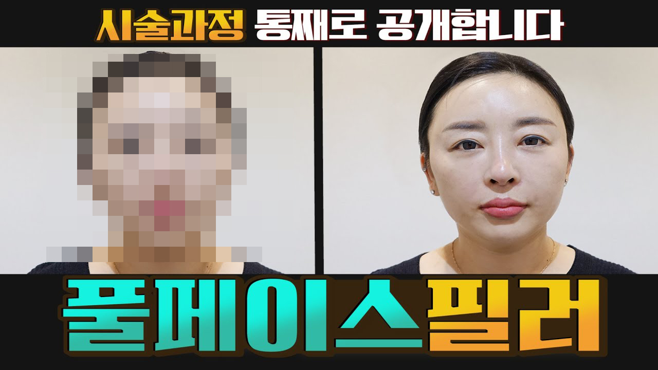 가출한 페이스볼륨 찾아주는 풀페이스필러 썸네일