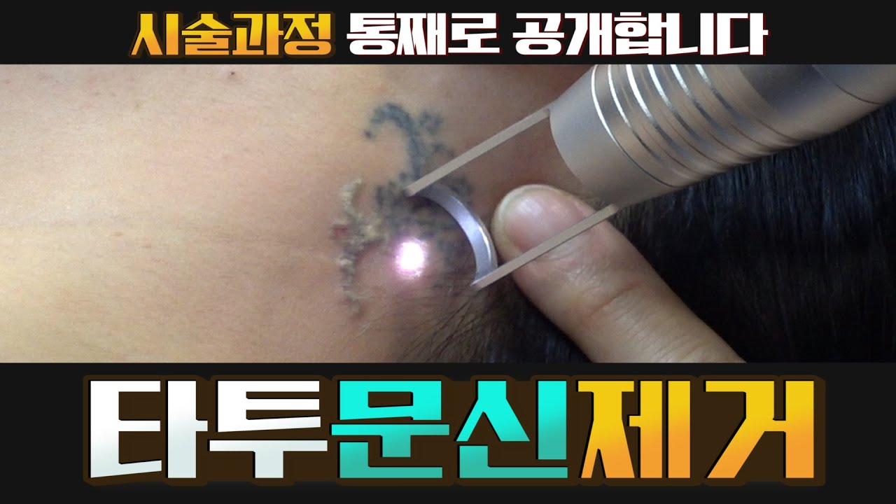 타투 문신 지워보자 썸네일