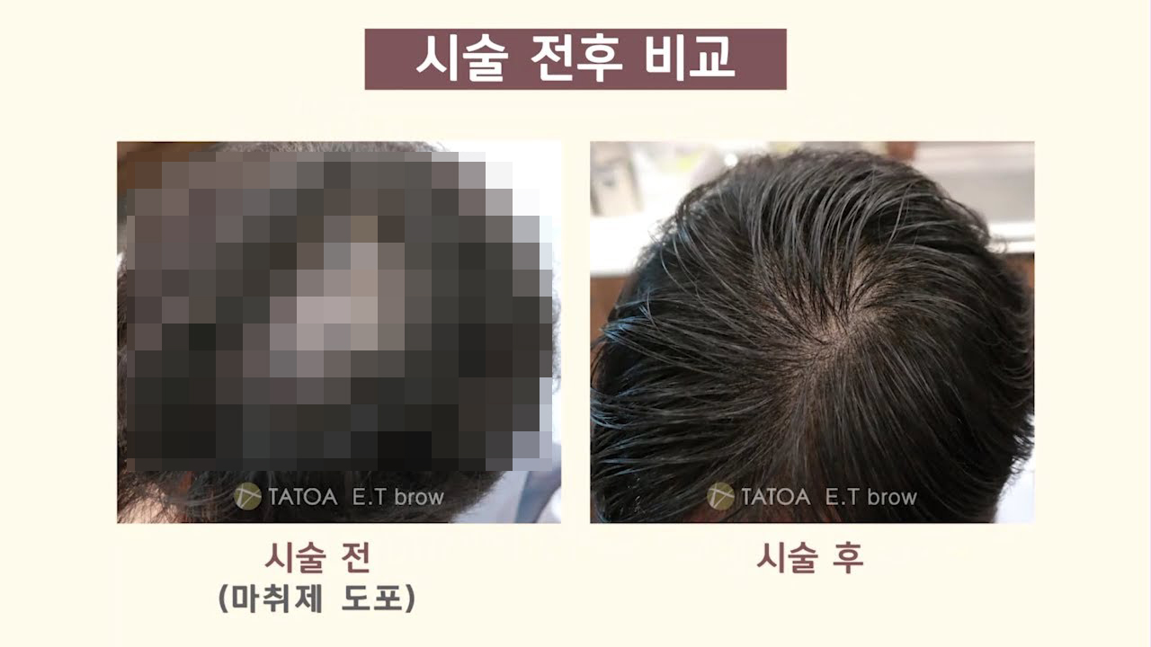 탈모 탈출에 필요한 시간 단 90분. 썸네일