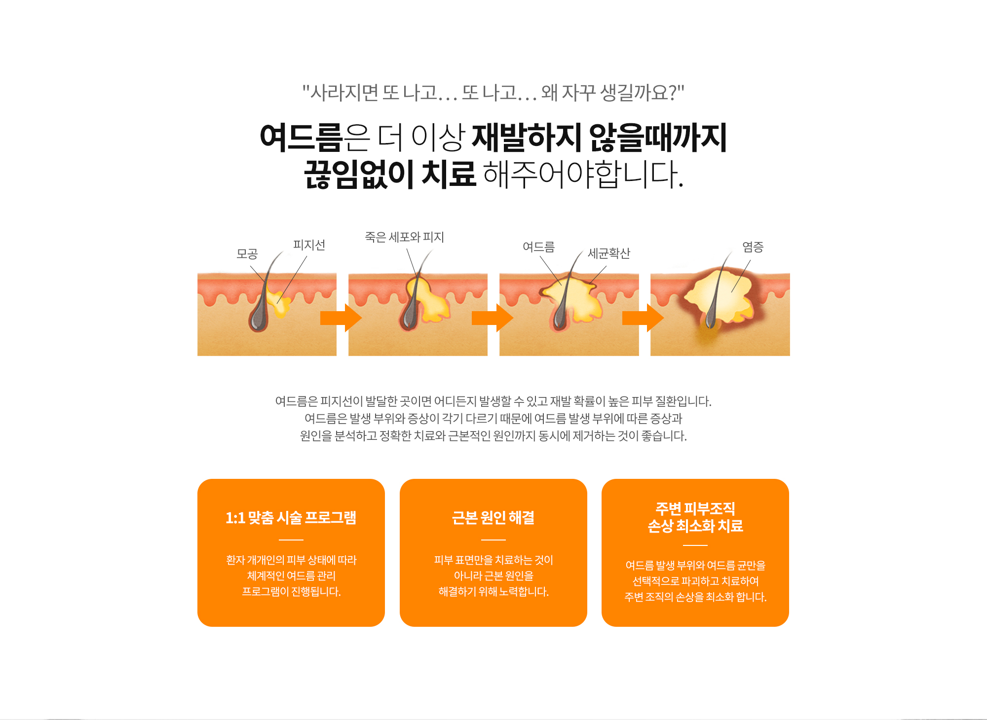 여드름치료