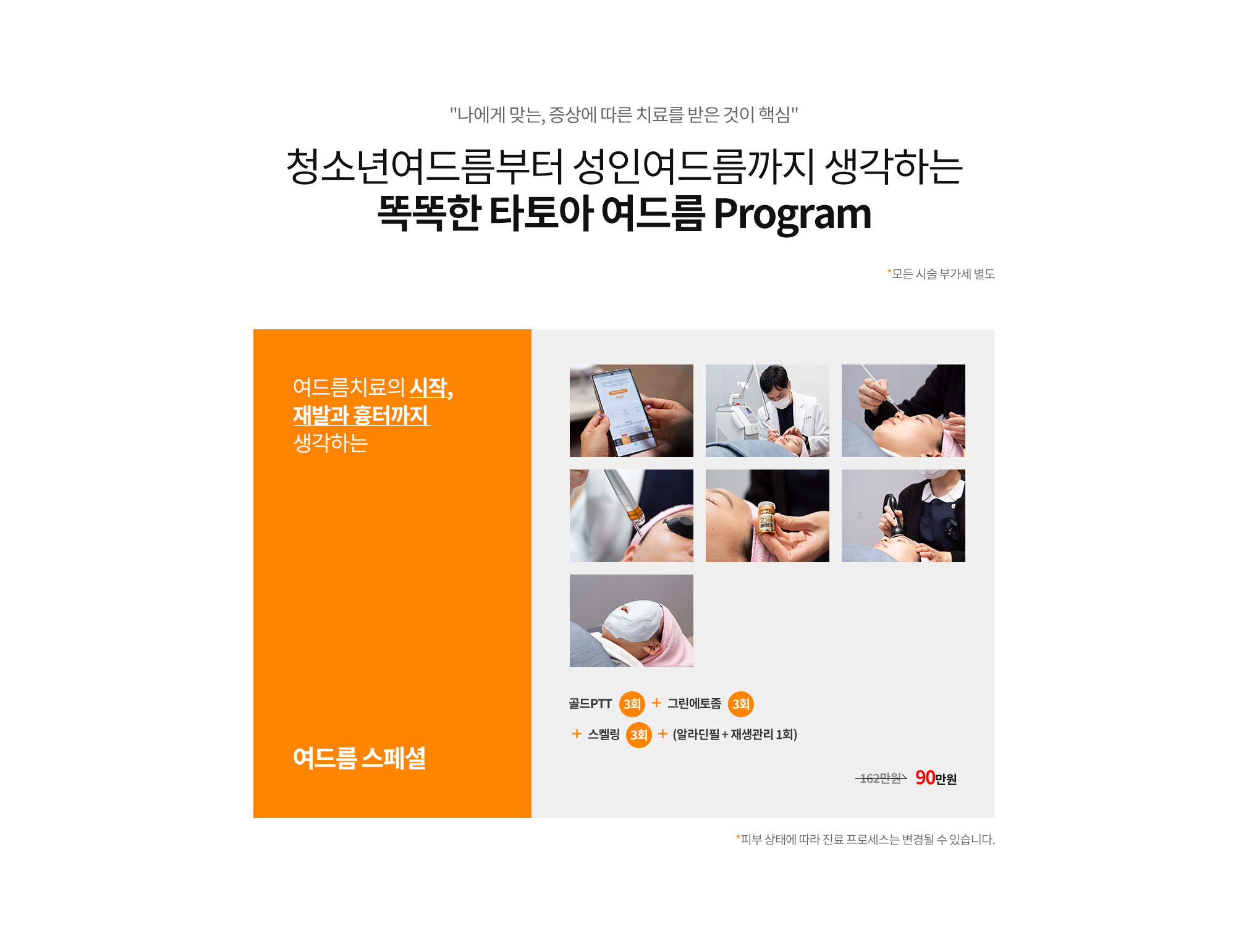 여드름치료